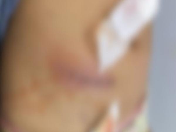 Sorriso: M&eacute;dicos "esquecem" res&iacute;duos dentro de crian&ccedil;a ap&oacute;s cirurgia no HRS, menina contrai infec&ccedil;&atilde;o e bact&eacute;ria, e precisa de outras duas cirurgias para "resolver" problema