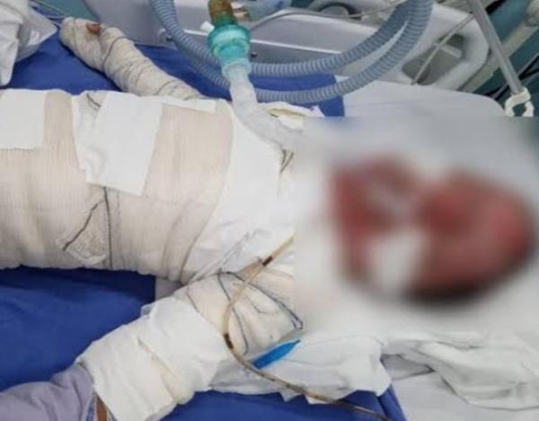 Lucas: Crian&ccedil;a morre com 90% do corpo queimado ap&oacute;s colocar fogo em colch&atilde;o enquanto brincava com isqueiro