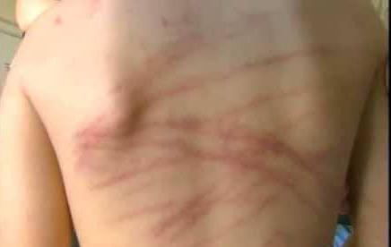 Mãe surra filho adotivo de 7 anos com chibatadas de cipó