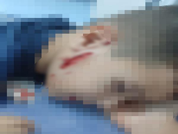 Sorriso: Cachorro solto na rua ataca e quase mata criança crianças no Fraternidade; PM foi ao local e criança foi parar no hospital