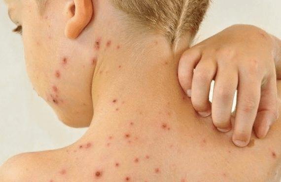 Saúde alerta para um possível surto de sarampo em Mato Grosso