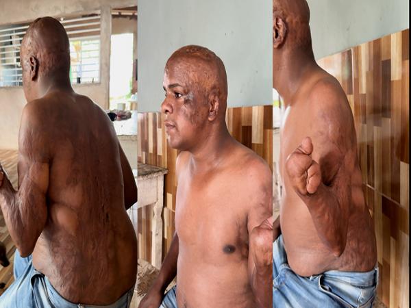 Jovem de Nortel&acirc;ndia que perdeu um bra&ccedil;o e um p&eacute; ap&oacute;s queimaduras tem per&iacute;cia do INSS negada por chegar 10 minutos atrasado em Cuiab&aacute;