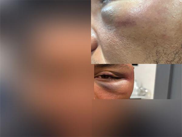 Sorriso: Homem leva murro no olho ap&oacute;s dizer que era PT durante discuss&atilde;o em conveni&ecirc;ncia