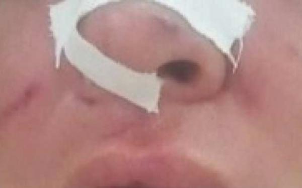 Sorriso: Mulher, 34 anos, é agredida pelo filho, de 15, e tem nariz quebrado a socos; Vítima diz que agressões foram ordenadas pelo pai do adolescente