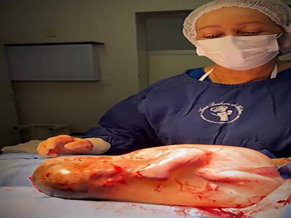 Sorriso: Beb&ecirc; nasce empelicado, acorda e rompe a pr&oacute;pria bolsa ao se espregui&ccedil;ar