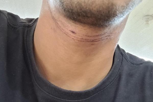 Sorriso: Empresário quase é degolado por fio de internet caído na Tancredo Neves