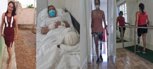 Sorriso: Edna, que teve perna arrancada em acidente, recebe prótese para voltar a andar