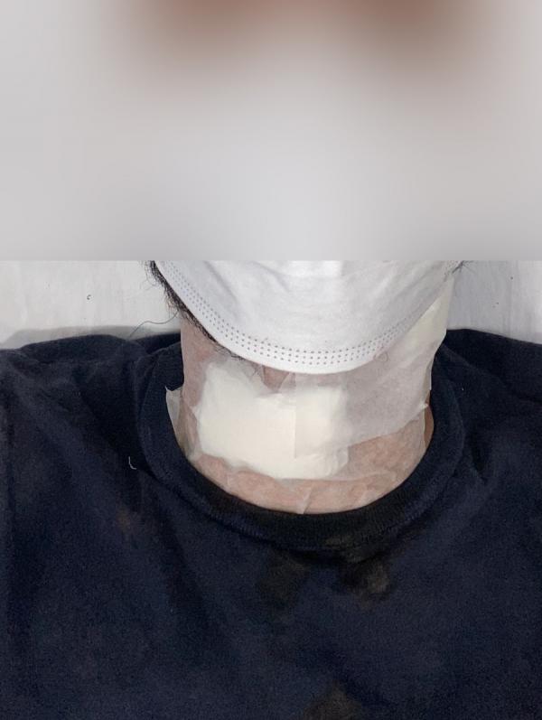 Sorriso: Homem leva 13 pontos no pesco&ccedil;o ap&oacute;s ter corte profundo provocado por linha com cerol, no Novo Horizonte