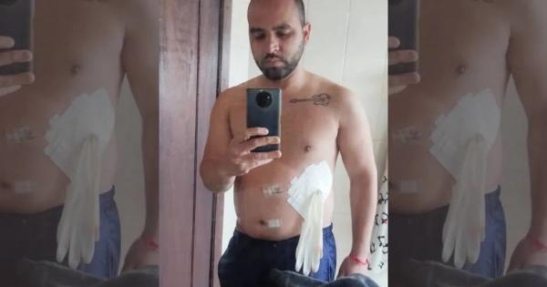 M&eacute;dico coloca luva cir&uacute;rgica no lugar de bolsa de colostomia em paciente: Falou que era medicina de guerra