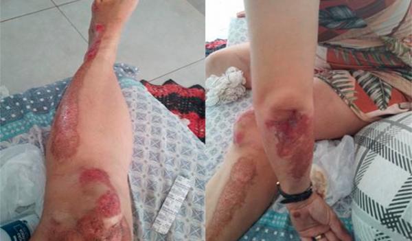 Sorriso: Mulher fica "Toda ralada" ap&oacute;s cachorro solto, na No&ecirc;mia Dalmolin, passar na sua fente