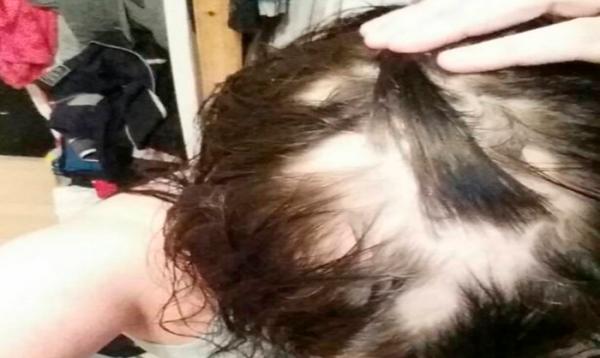 Sorriso: Mulher fica quase careca ap&oacute;s cabeleireira "testar" novo produto para deixar cabelo "bonito e sedoso"