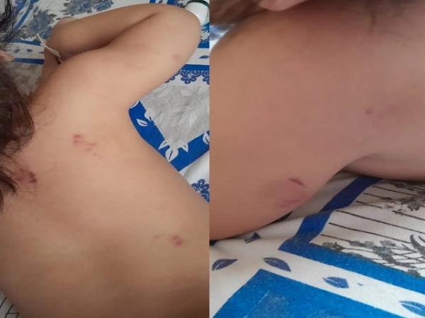 MT: Beb&ecirc; de 1 ano volta para casa com cerca de 17 mordidas e pais denunciam creche particular