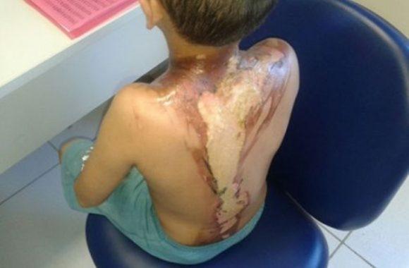 Madrasta joga água fervente em enteado por encontrar a casa desarrumada