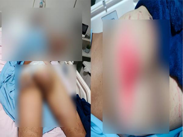 Sorriso: Homem vai a hospital fazer cirurgia no nariz e sofre queimadura de segundo grau nas n&aacute;degas