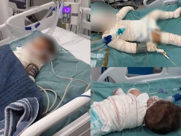 MT: Beb&ecirc;, de 1 ano, morre com graves queimaduras ap&oacute;s explos&atilde;o de churrasqueira
