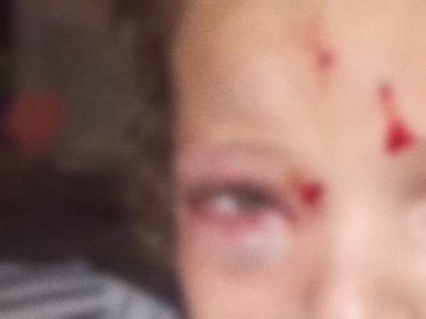 Sorriso: Crian&ccedil;a, de 4 anos, &eacute; internada ap&oacute;s ser atacada por cachorro na rua, no Brasil Norte