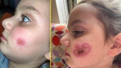 Criança vai parar em hospital após receber beijo na bocheca e ter infecção
