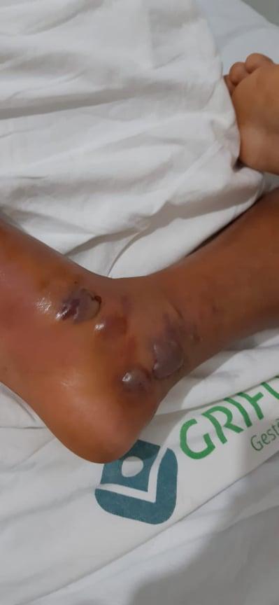 Menino de 12 anos é picado por cobra jararaca